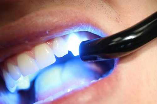 Отбеливание зубов лазером: особенности процедуры