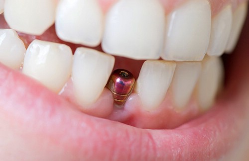 Имплантация зубов: красивая улыбка навсегда