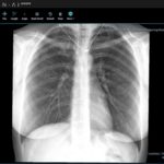Преимущества AI-платформы для анализа компьютерных томограмм лёгких