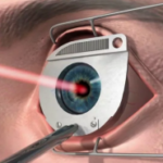 Когда требуется лазерная коррекция зрения?